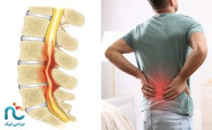 تنگی کانال نخاعی