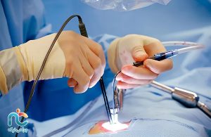 عمل ليزر ديسك كمر