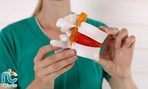 دیسک گردن شدید