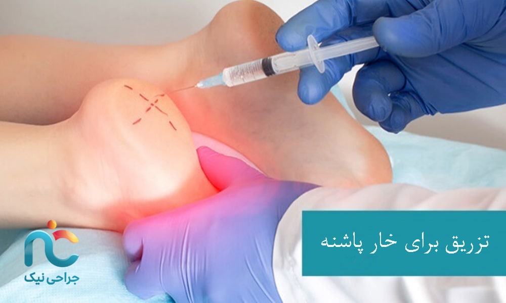 تزریق برای خار پاشنه