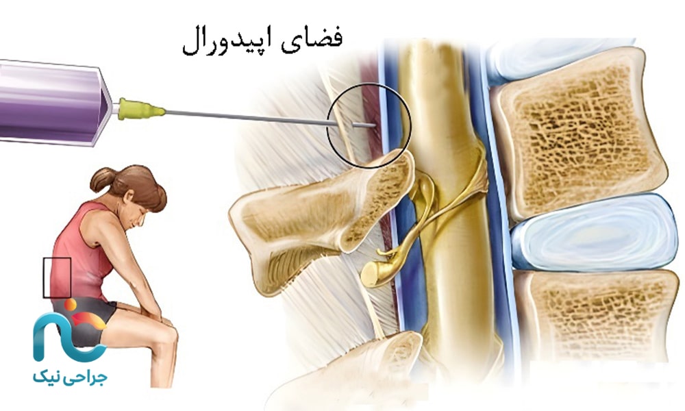 فضای اپیدورال