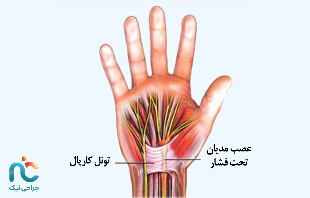 سندورم تونل کارپال