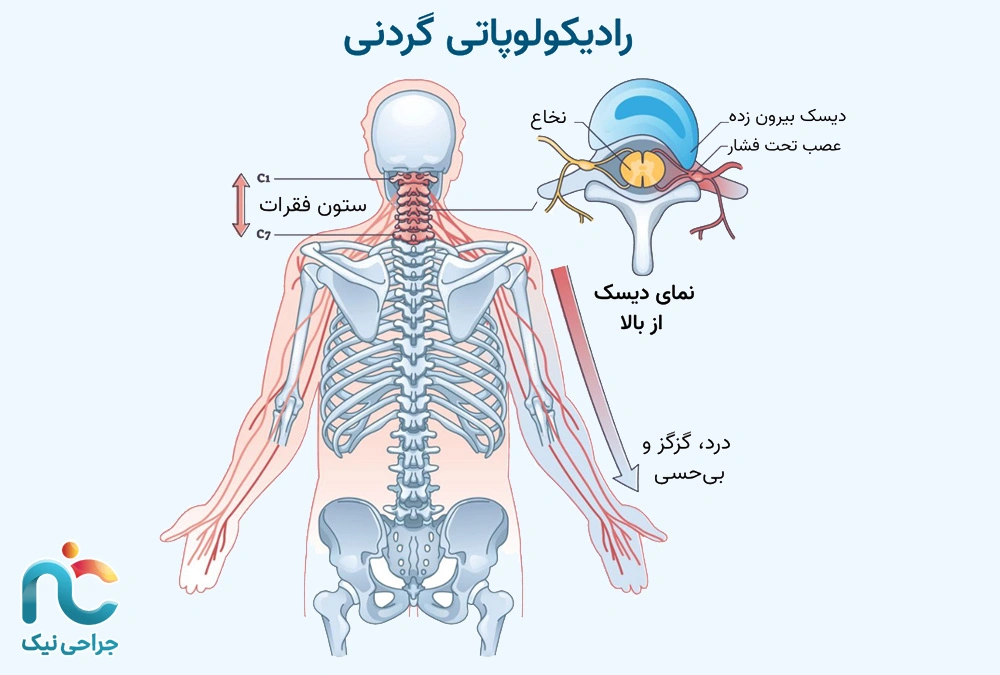 رادیکولوپاتی گردنی