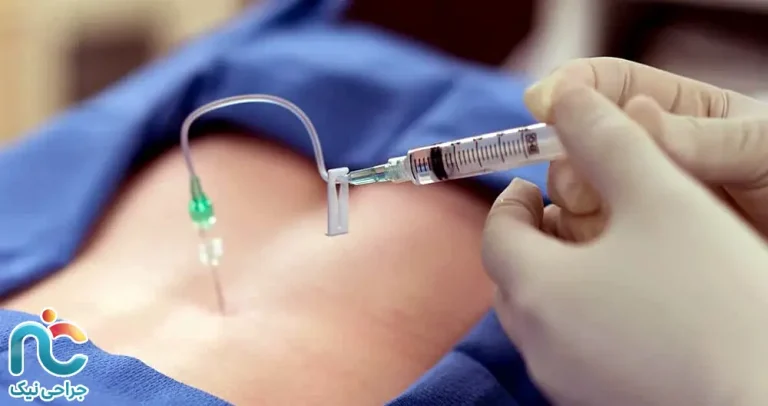 تزریق کورتون در دیسک کمر