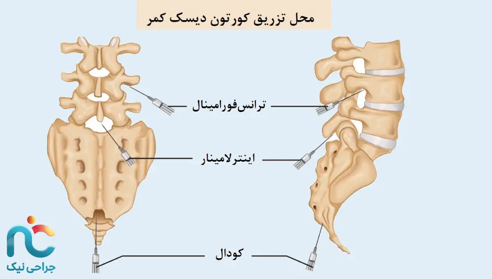 محل تزریق کورتون در دیسک
