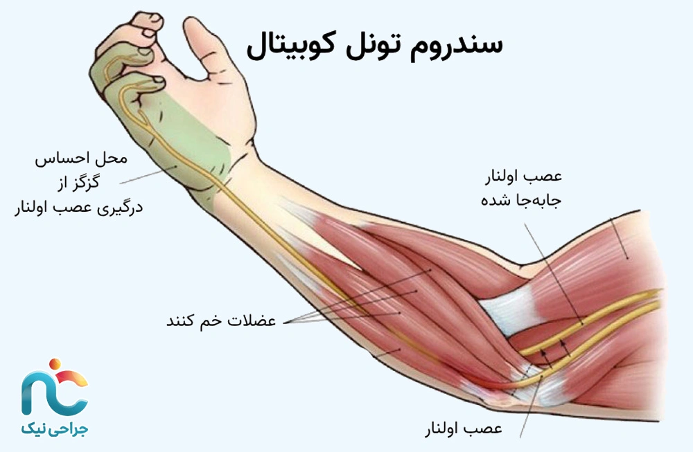سندروم تونل کوبیتال