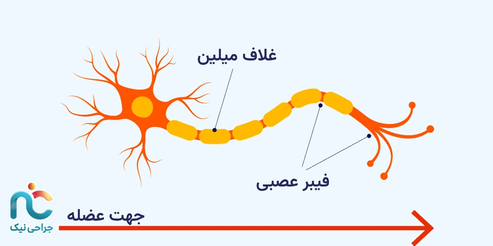 دیابت شایع‌ترین علت نوروپاتی