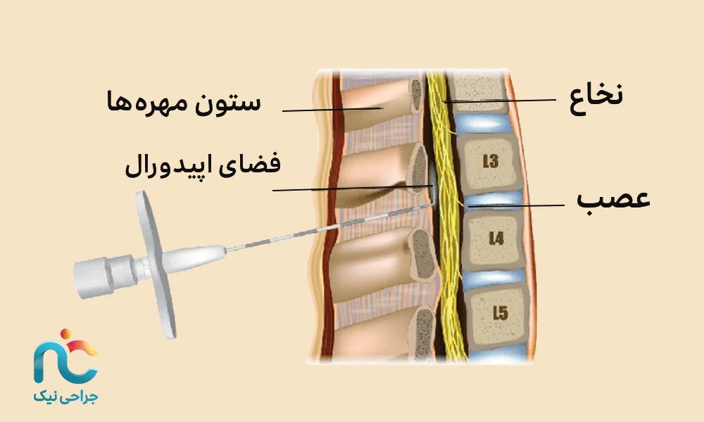 تزریق اپیدورال (نزدیک نخاع)