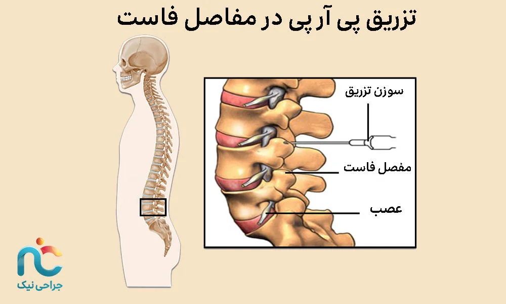 تزریق در مفاصل فاست