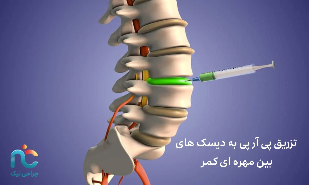 تزریق پی آر پی به دیسک های بین مهره ای کمر