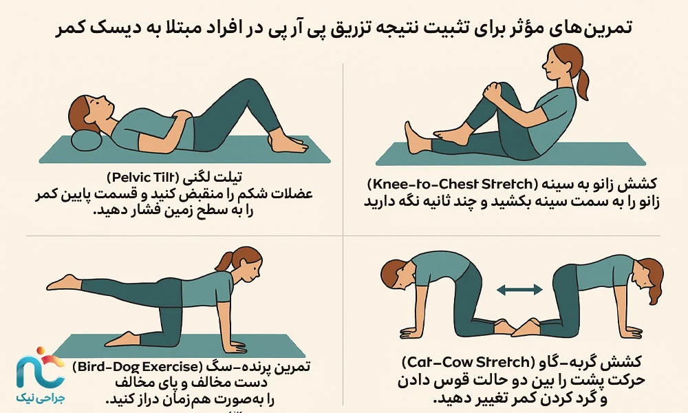 تمرین‌های مؤثر برای تثبیت نتیجه تزریق پی آر پی در افراد مبتلا به دیسک کمر