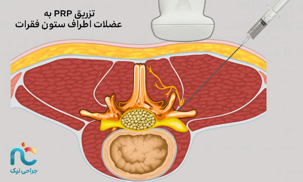 تزریق در عضلات اطراف ستون فقرات