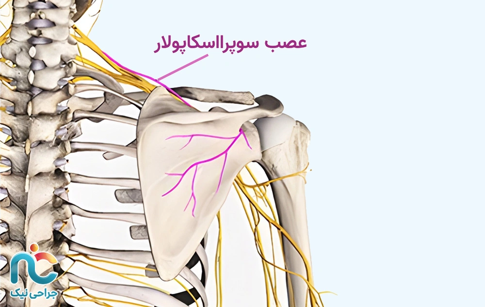 گیر افتادگی عصب