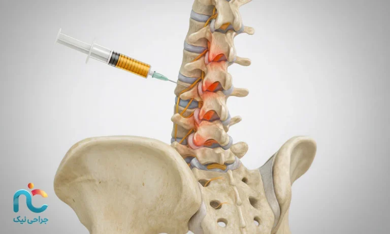 پی‌آر‌پی دیسک کمر