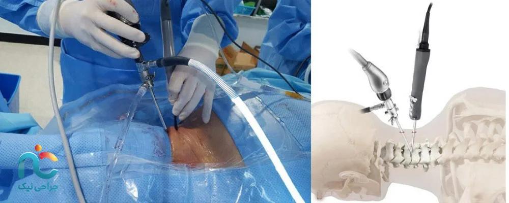 چگونگی جراحی اندوسکوپیک دیسک گردن؛ نگاهی از اتاق عمل 