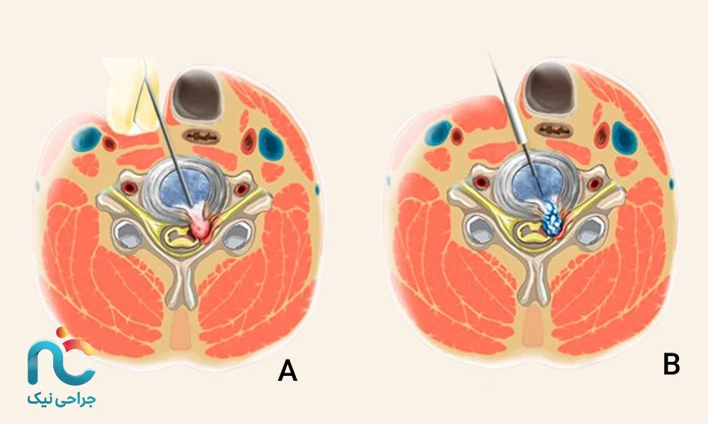 با جراحی اندوسکوپیک دیسک گردن چه اتفاقاتی در بدن میفتد