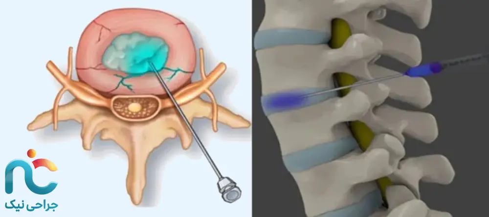 تزریق داخل دیسک