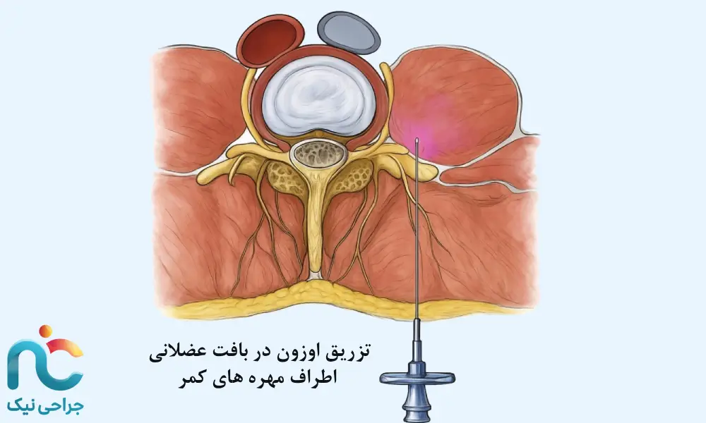 تزریق عضلانی