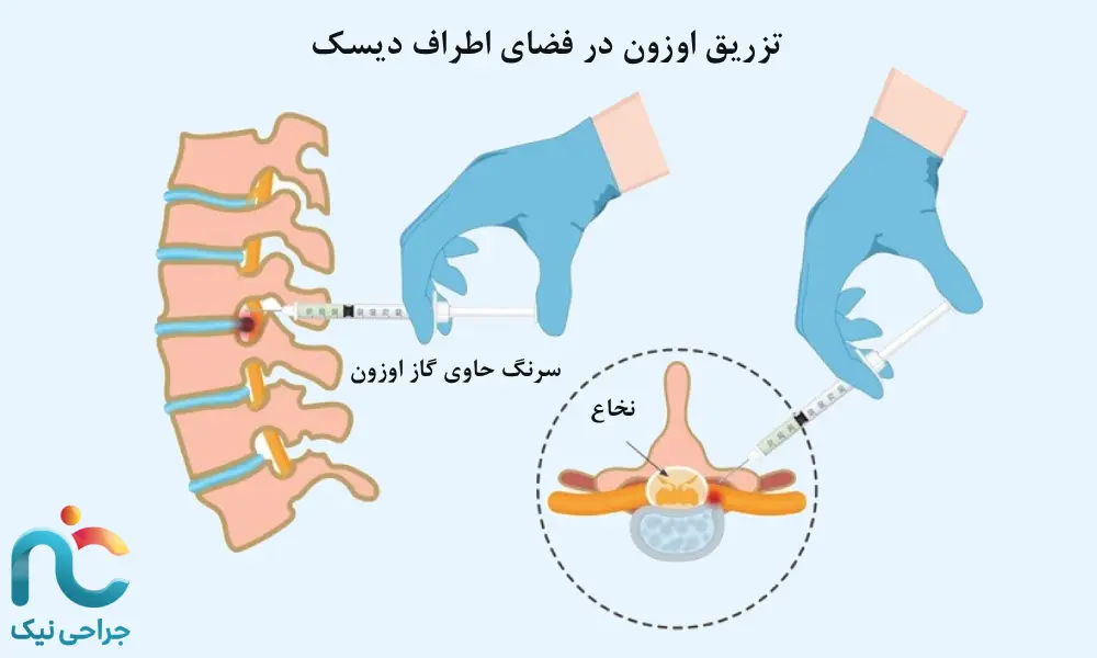 تزریق اطراف دیسک