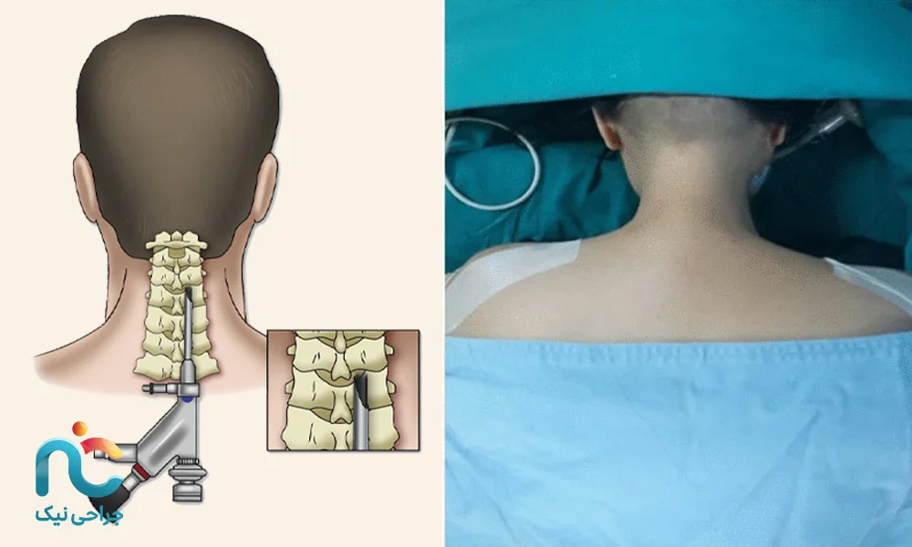 روش خلفی (Posterior Approach)