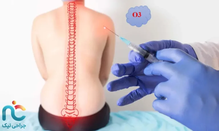 اوزون‌تراپی دیسک کمر