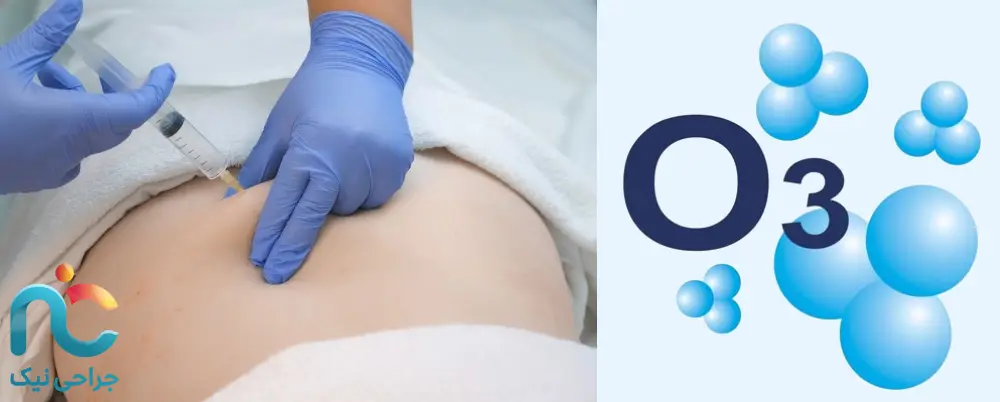 اوزون‌تراپی دیسک کمر