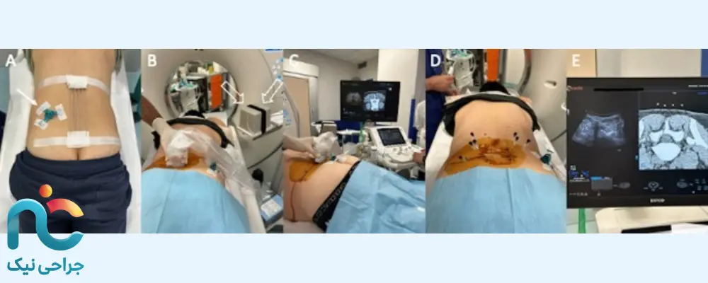 تزریق اوزون