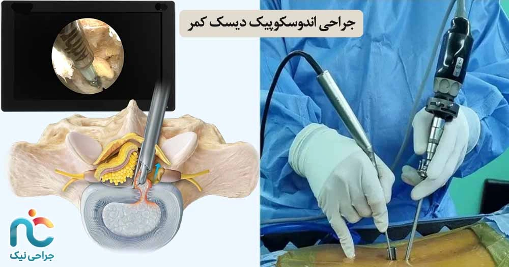 جراحی اندوسکوپیک دیسک کمر