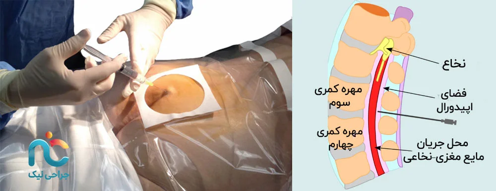 تزریق اپیدورال کودال دقیقا چیست و چگونه انجام می‌شود؟