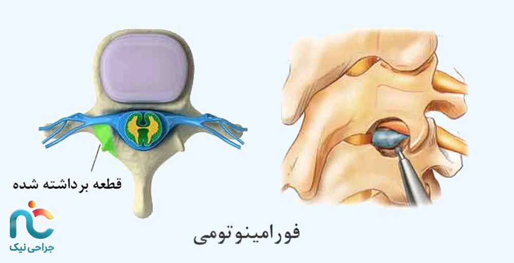 فورامینوتومی