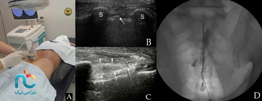 روند انجام تزریق چگونه است