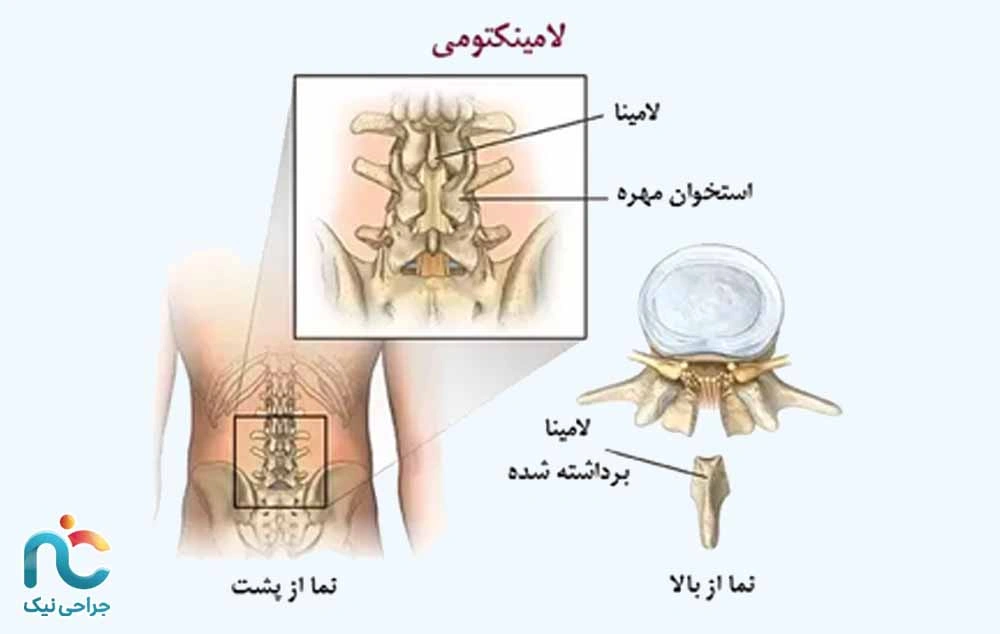 لامینوتومی