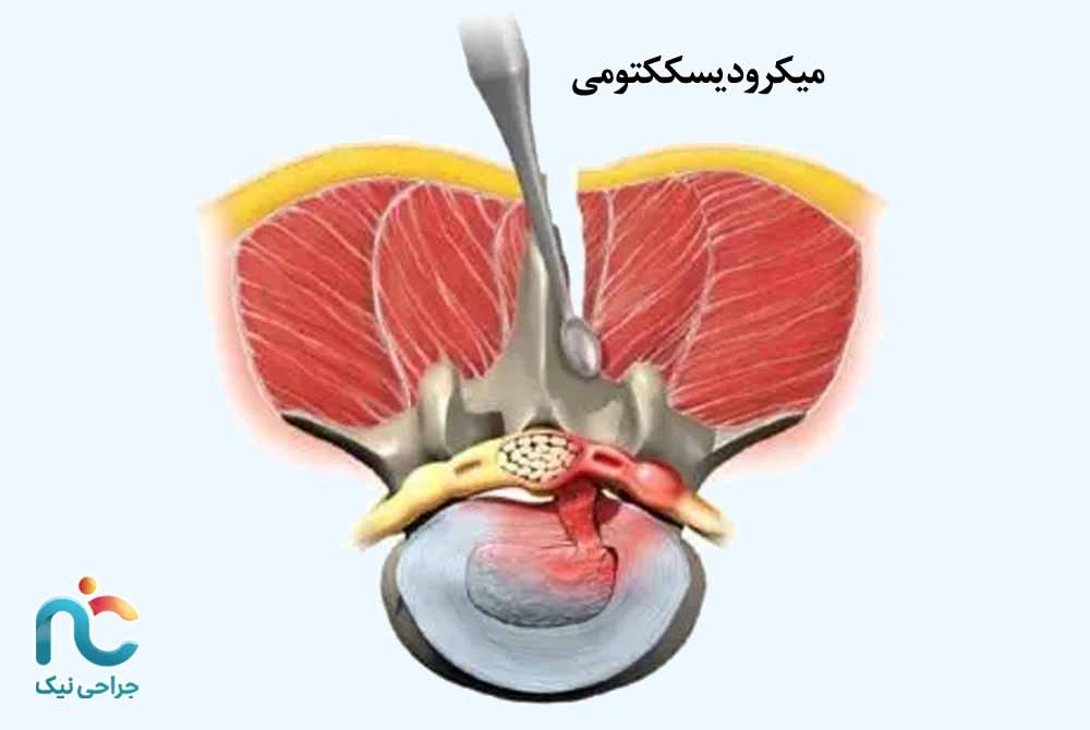 میکرودیسککتومی