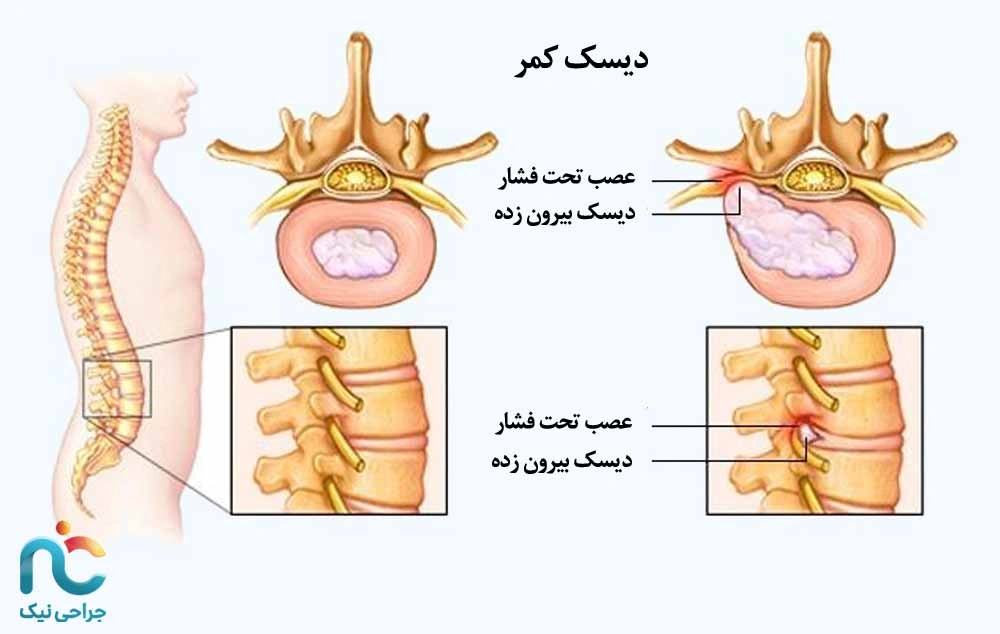 درد نوروپاتیک