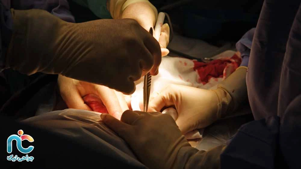 احتمالا جراحی