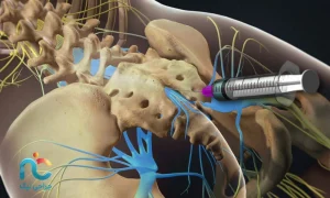 تزریق اپیدورال کودال