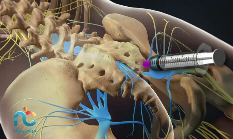 تزریق اپیدورال کودال