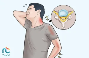تزریق آمپول دیسک گردن