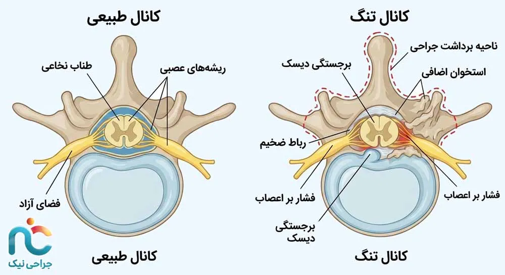 لامینا