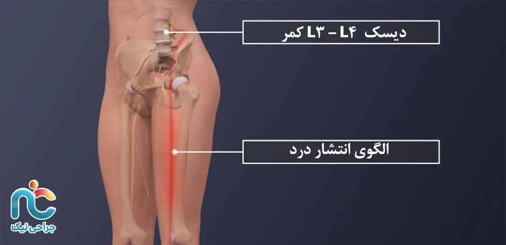 دیسک L3–L4کمر