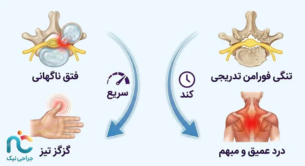 فشار روی عصب C6