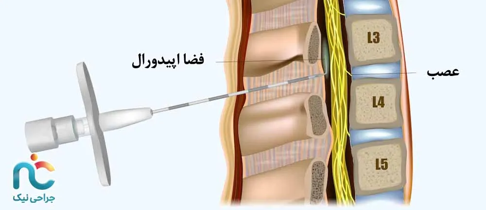 فضا اپیدورال